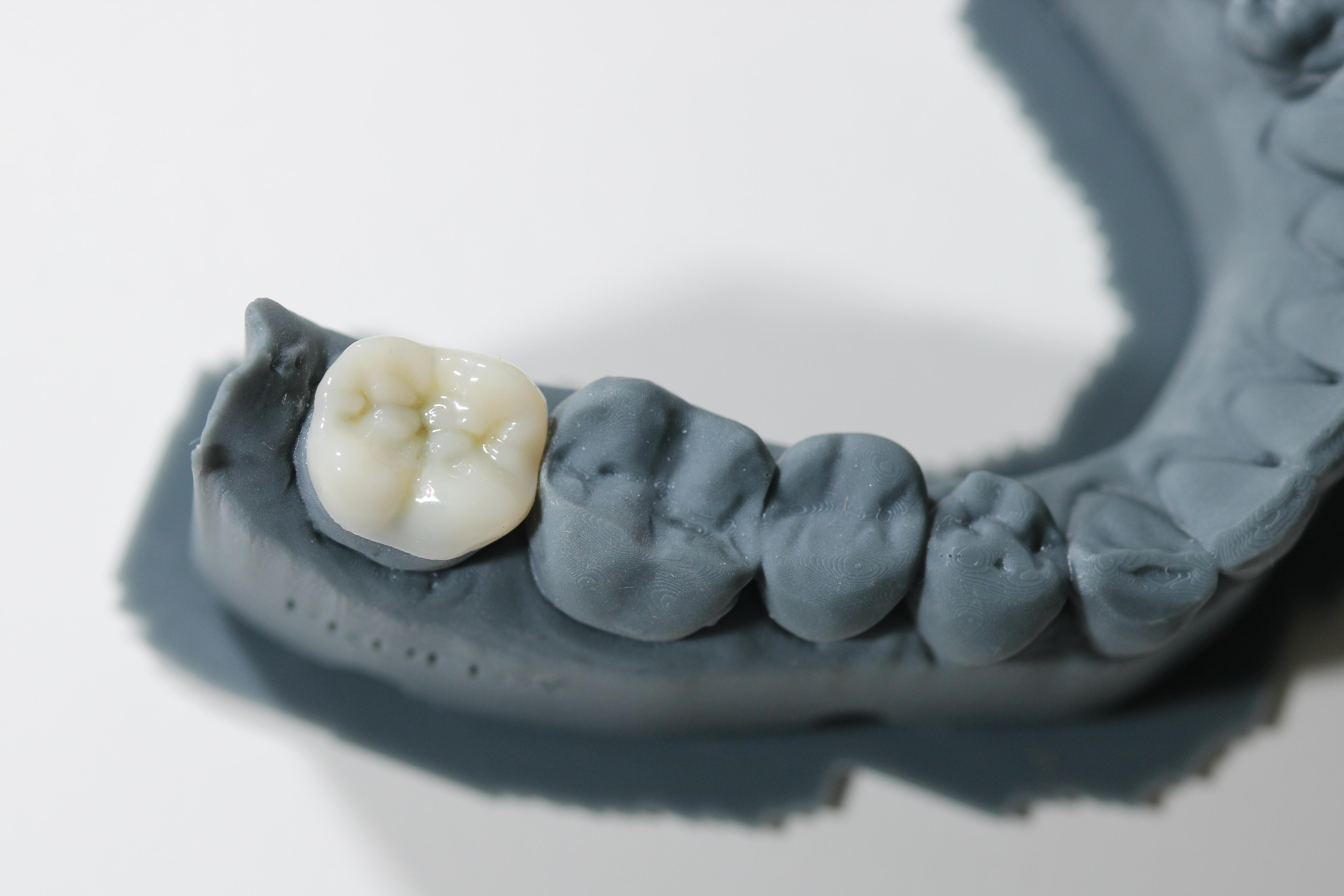 Incrustación dental